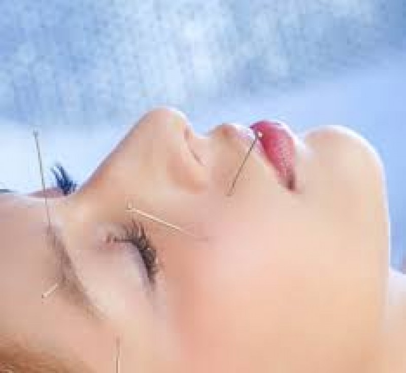 Acupuncture as an add-on therapy to sublingual allergen-specific immunotherapy for patients with allergic rhinitis.