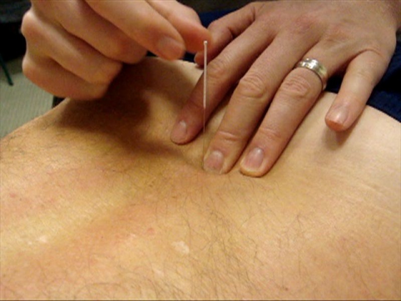 The role of touch in acupuncture treatment